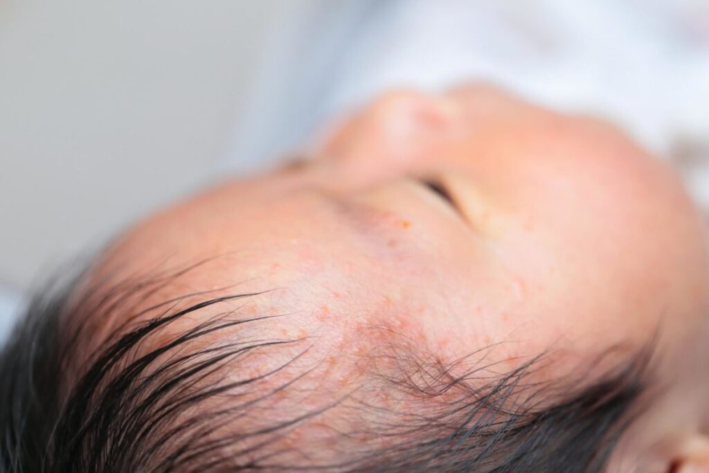 【赤ちゃんのアトピー性皮膚炎】その原因は？どう対処する？